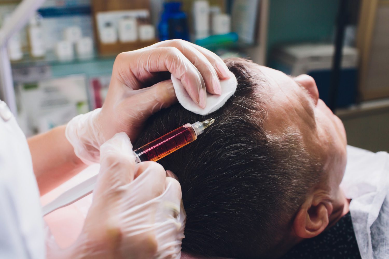 Hair restoration PRF
