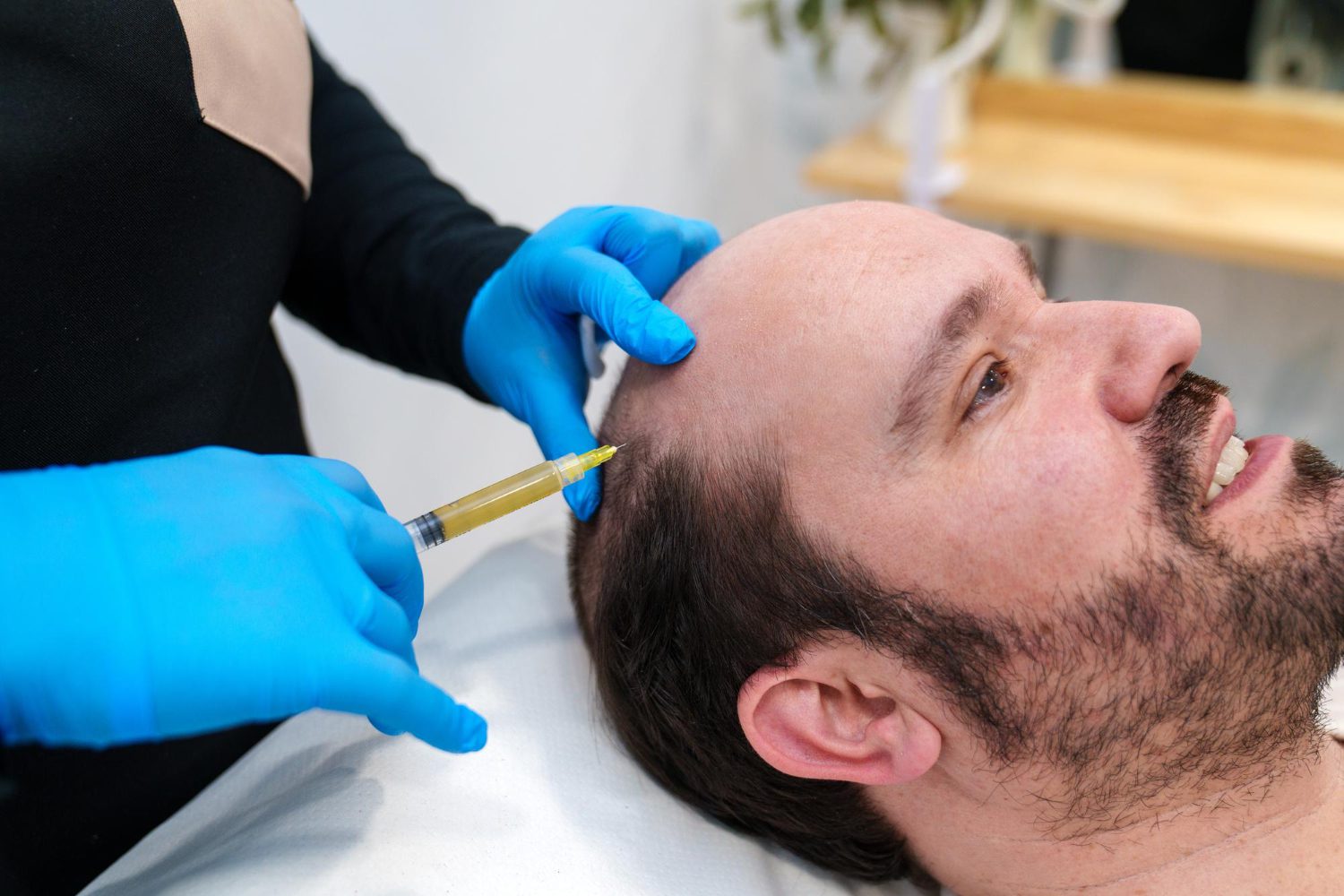 PRP scalp treatment being performed on a patient with thinning hair