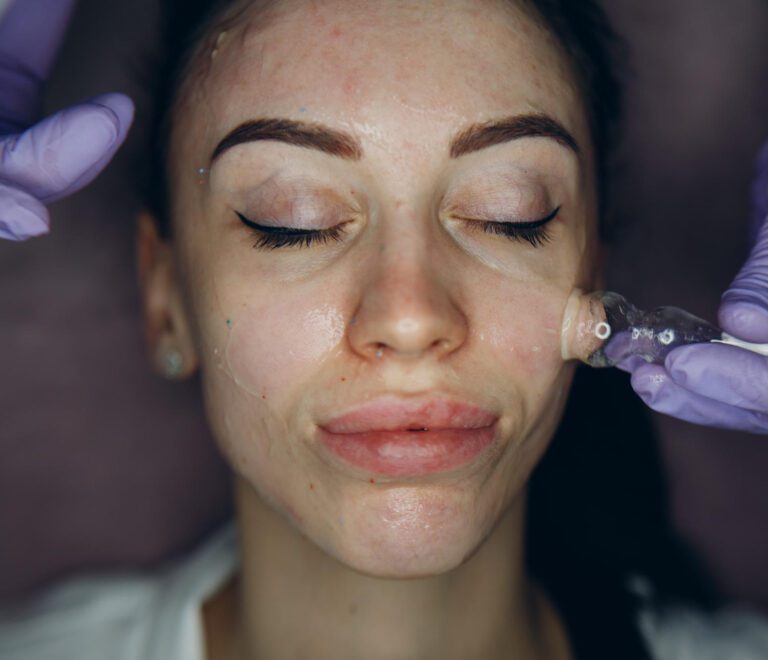 RF Microneedling for Acne Scars: What to Know Before Treatment