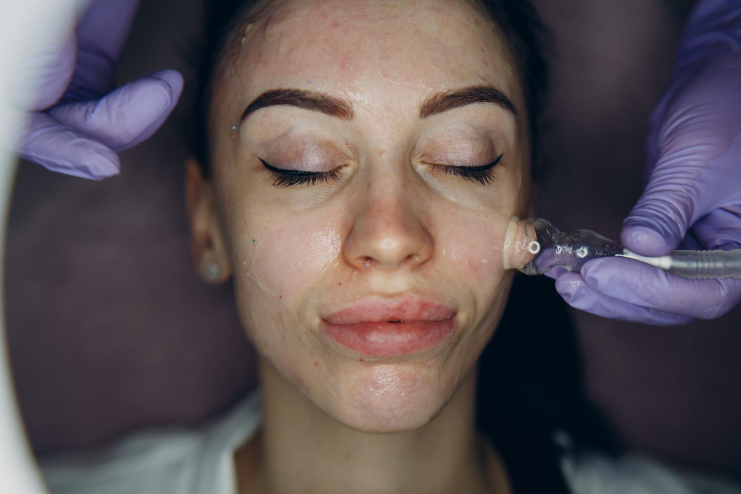 Provider performing RF microneedling on facial skin with visible acne scarring