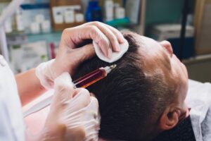 Hair restoration PRF