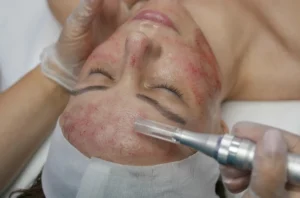Microneedling aftercare tips for healthy skin at H-Bling Wellness in Brea CA